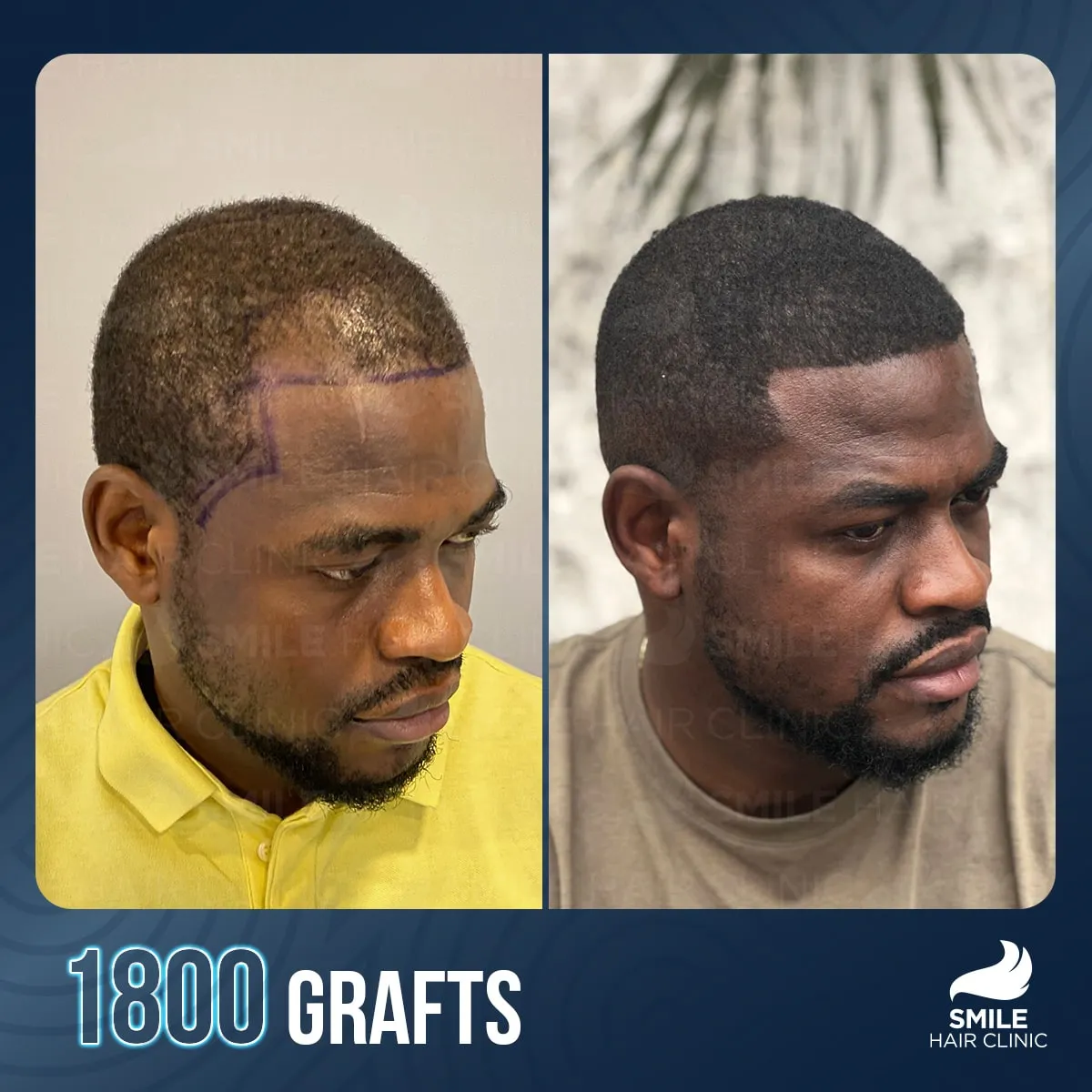 Transformationsergebnis einer Haartransplantation