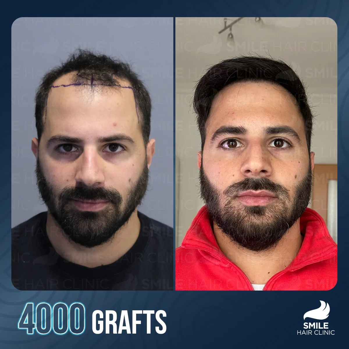 Transformationsergebnis einer Haartransplantation