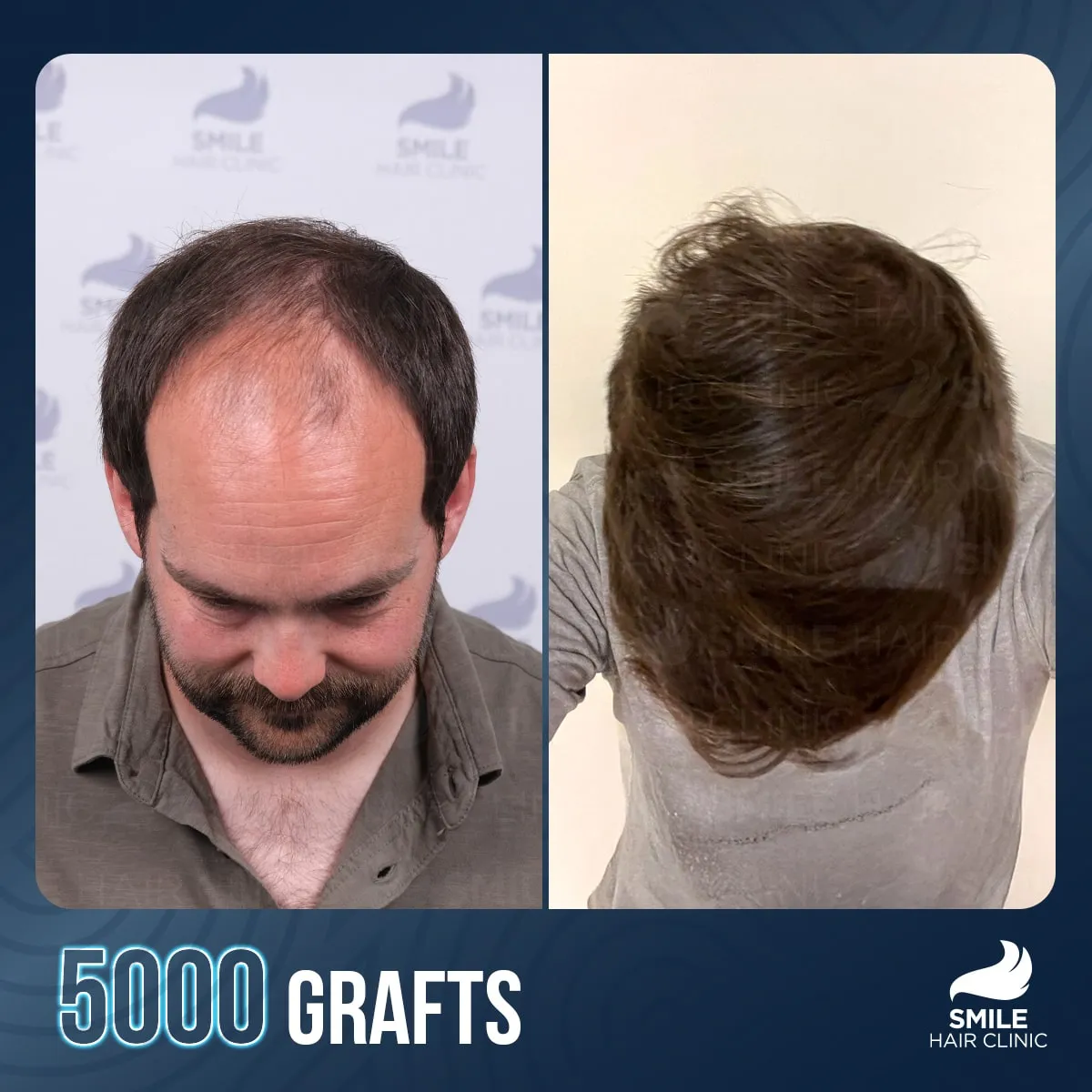 Transformationsergebnis einer Haartransplantation