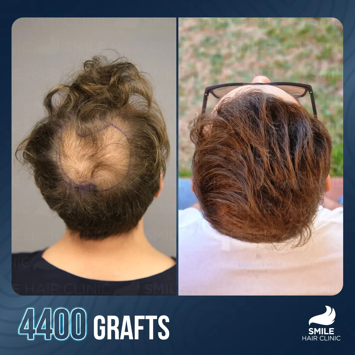 Transformationsergebnis einer Haartransplantation