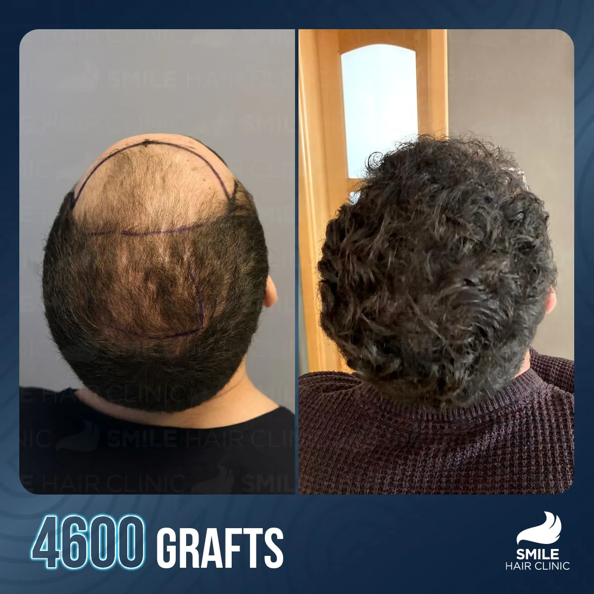 Transformationsergebnis einer Haartransplantation