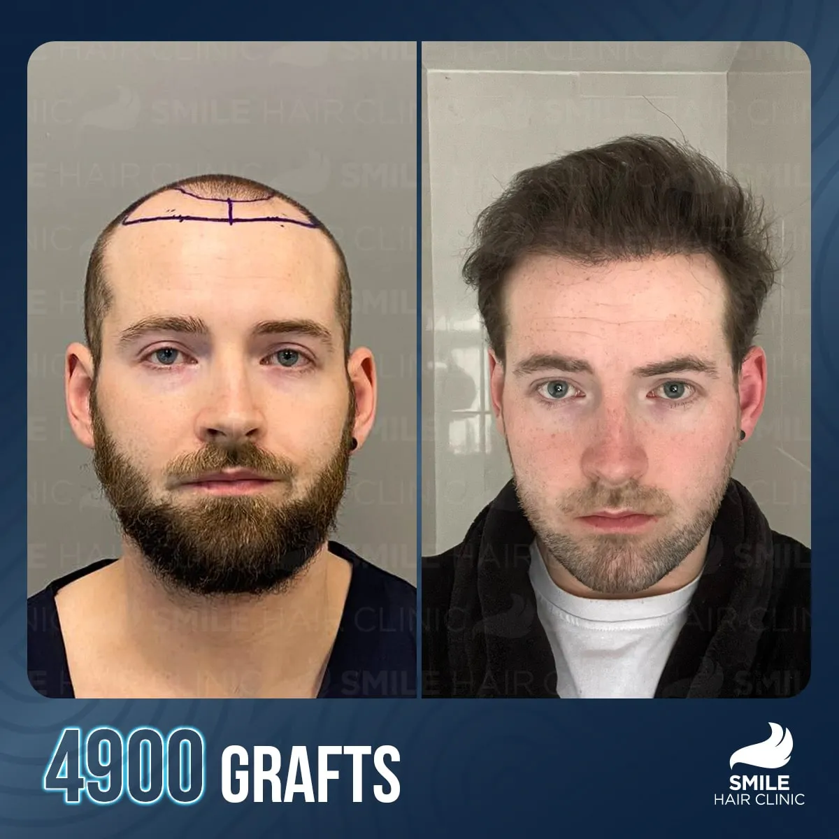 Transformationsergebnis einer Haartransplantation