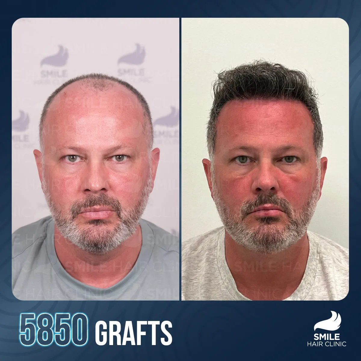 Transformationsergebnis einer Haartransplantation