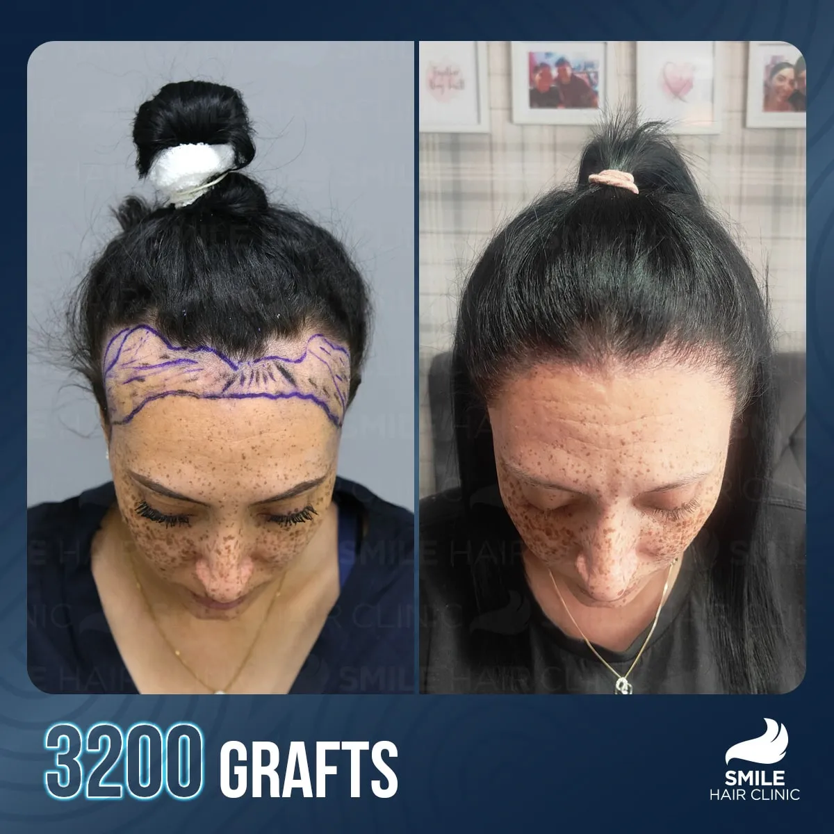 Transformationsergebnis einer Haartransplantation