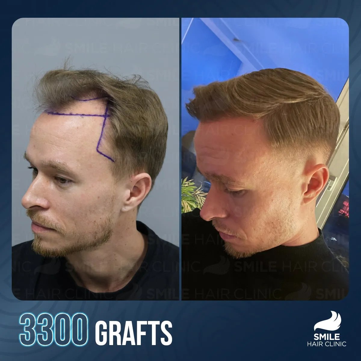 Transformationsergebnis einer Haartransplantation