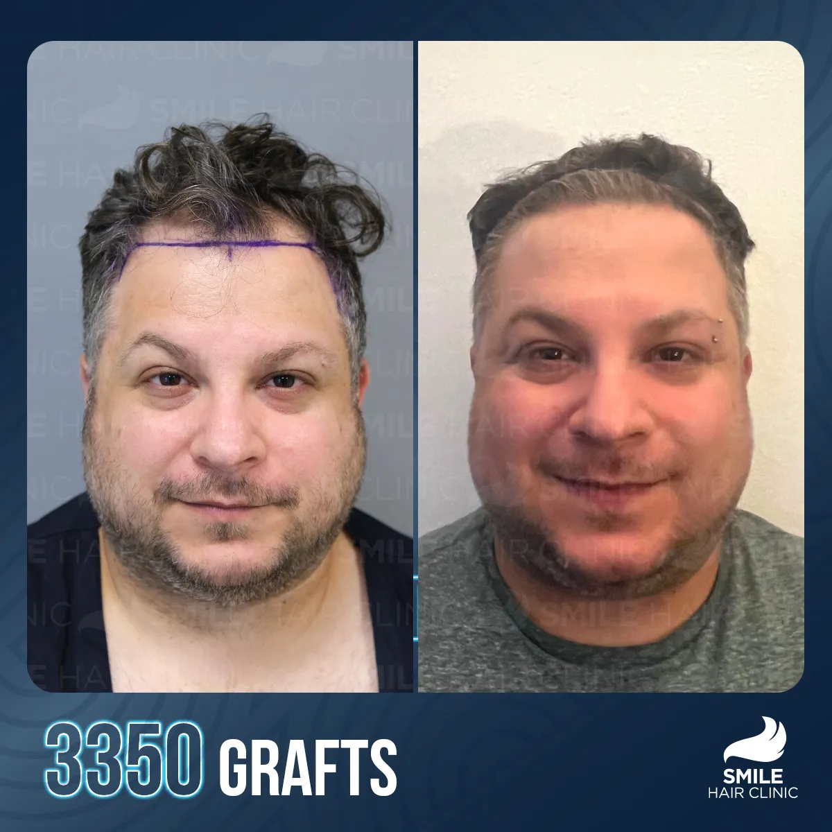 Haartransplantationsergebnis 1