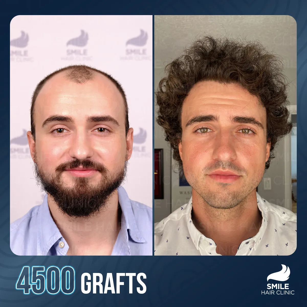 Haartransplantationsergebnis 10