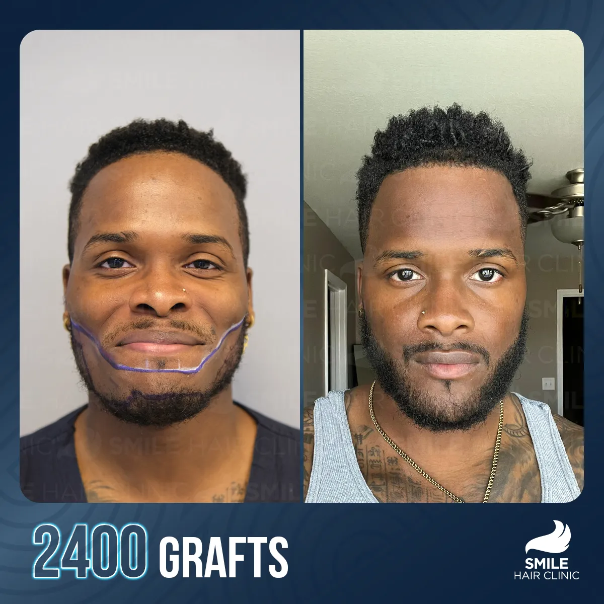 Haartransplantationsergebnis 11