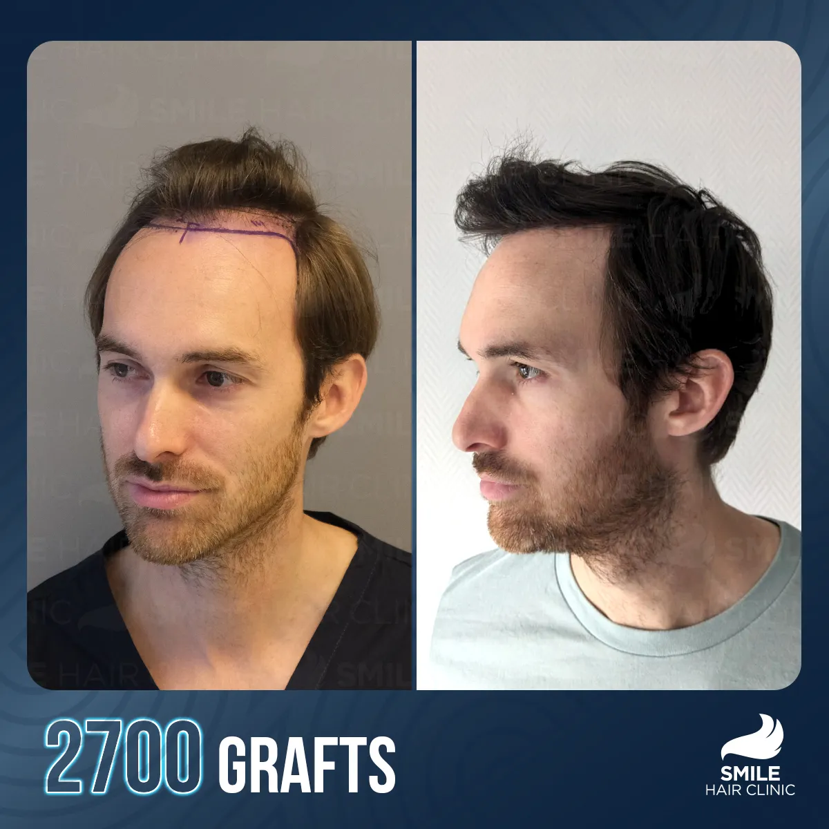 Haartransplantationsergebnis 12