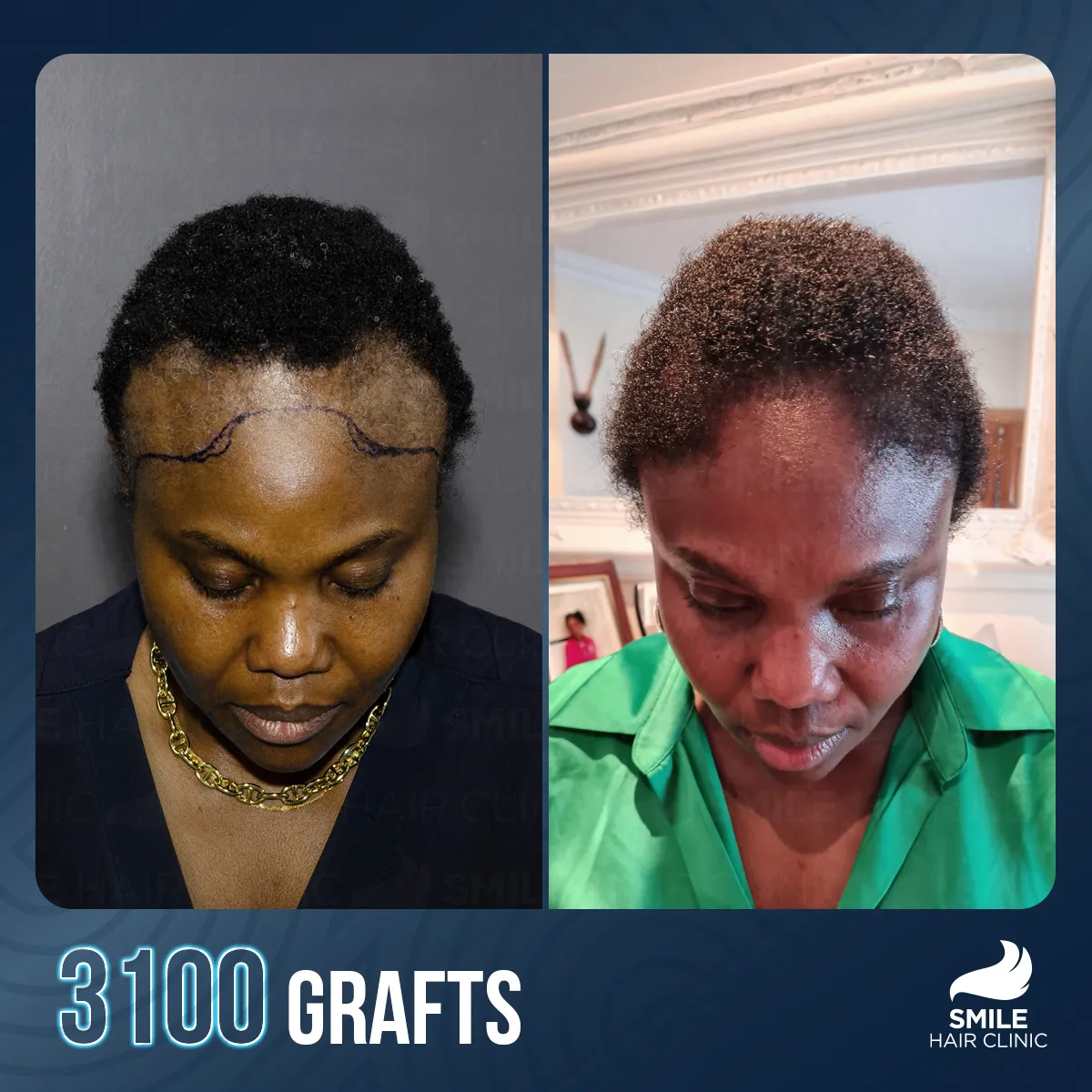 Haartransplantationsergebnis 13