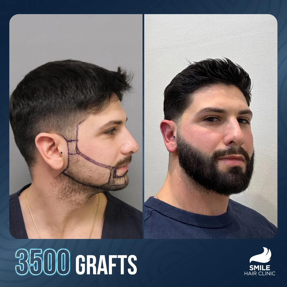 Haartransplantationsergebnis 14