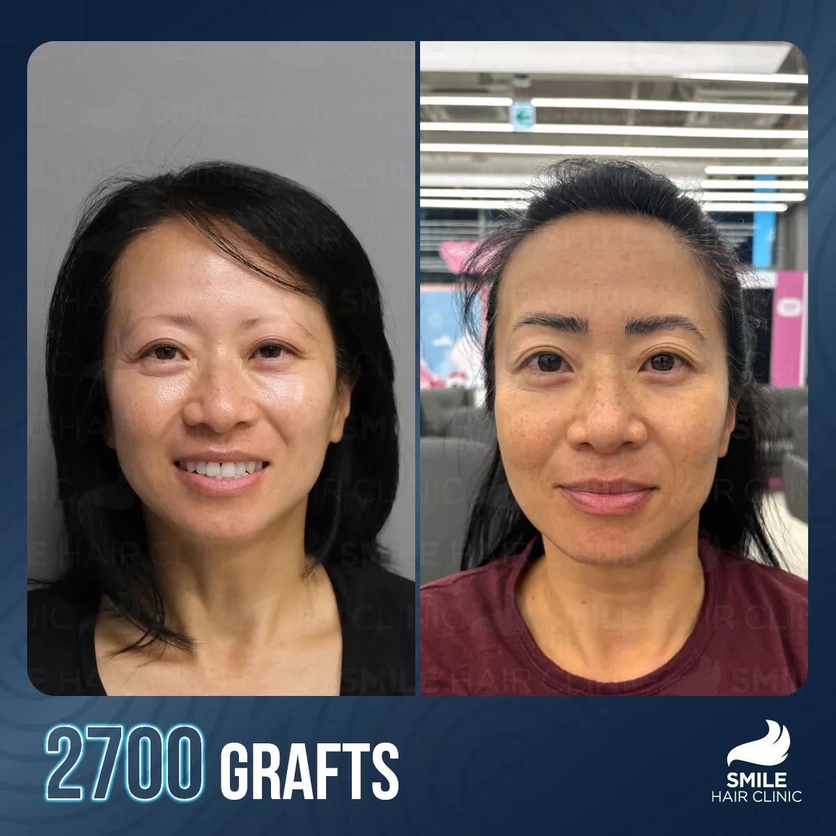 Haartransplantationsergebnis 15