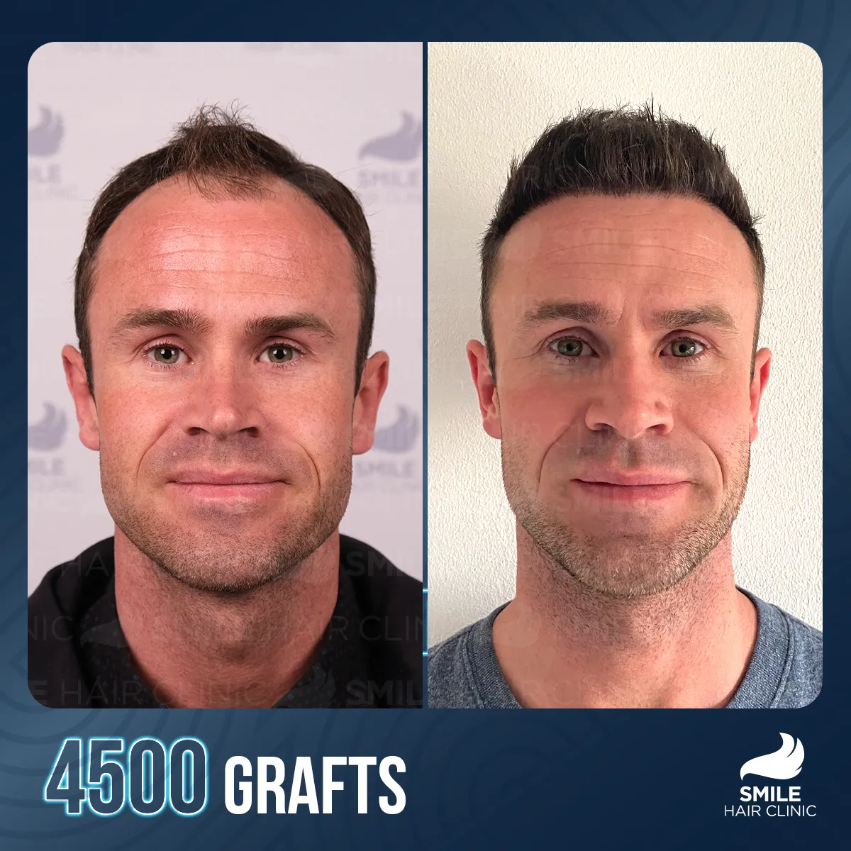 Haartransplantationsergebnis 2