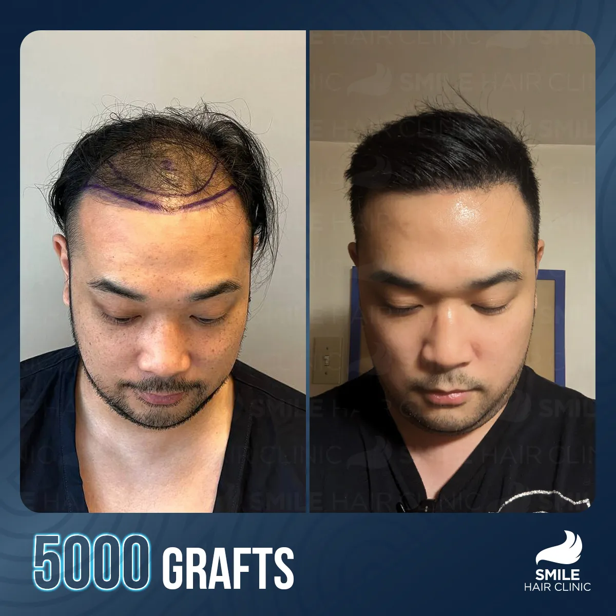 Haartransplantationsergebnis 3