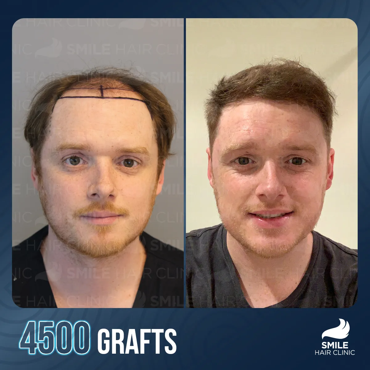 Haartransplantationsergebnis 4