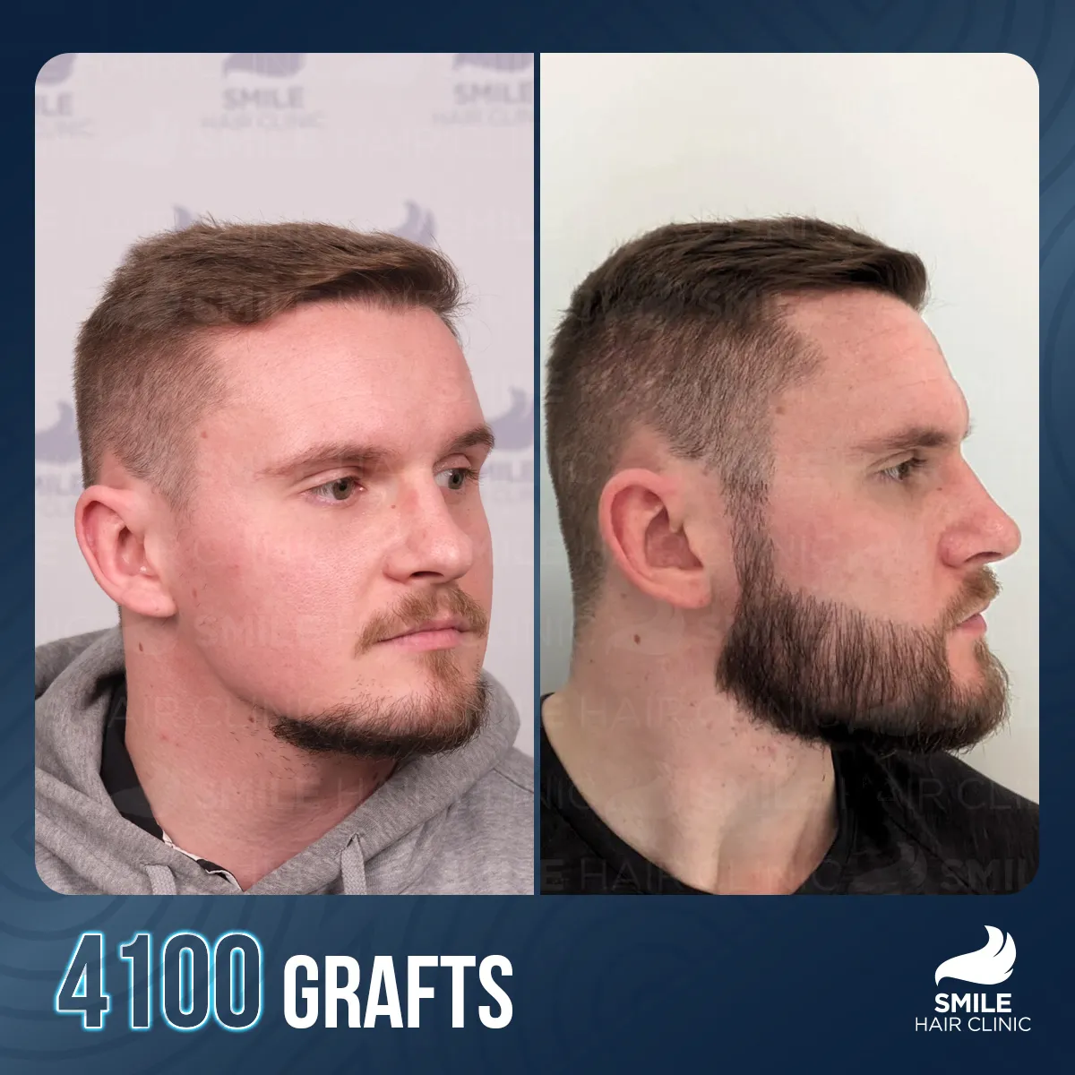 Haartransplantationsergebnis 6