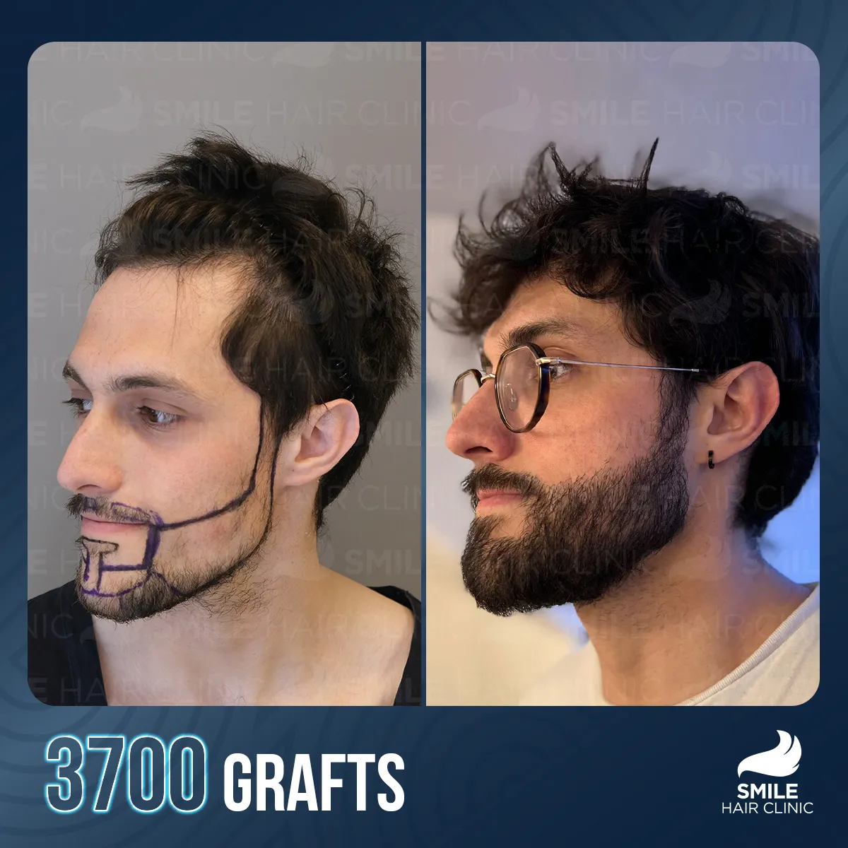 Haartransplantationsergebnis 7