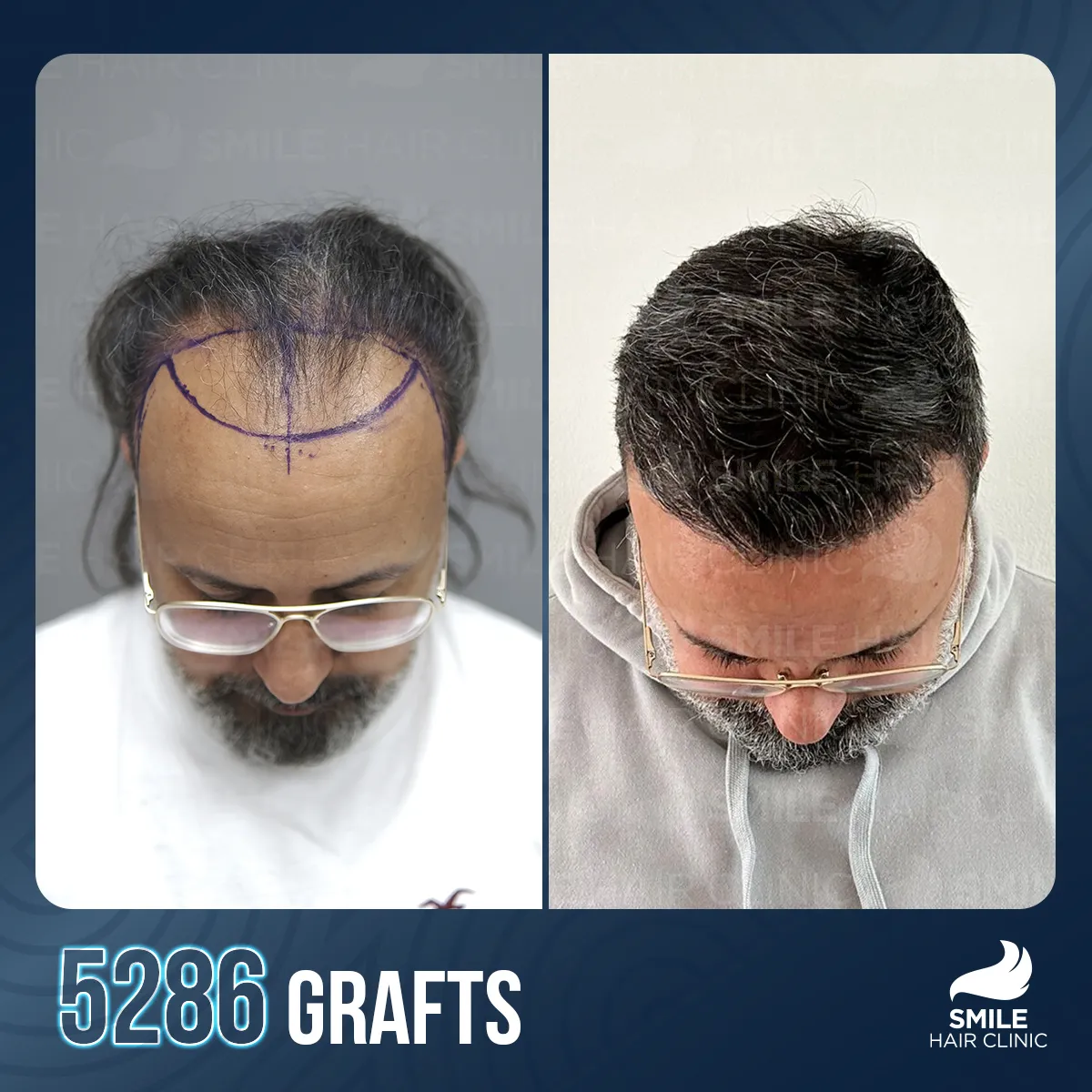 Haartransplantationsergebnis 8