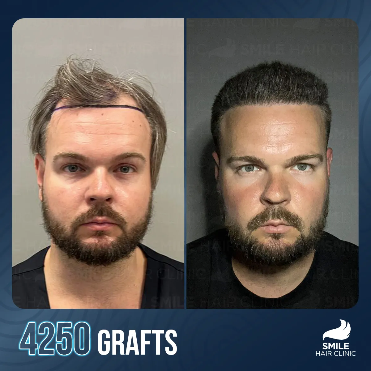 Haartransplantationsergebnis 9